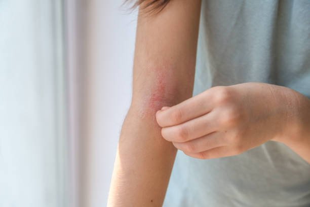 Skin Allergy & Rashes